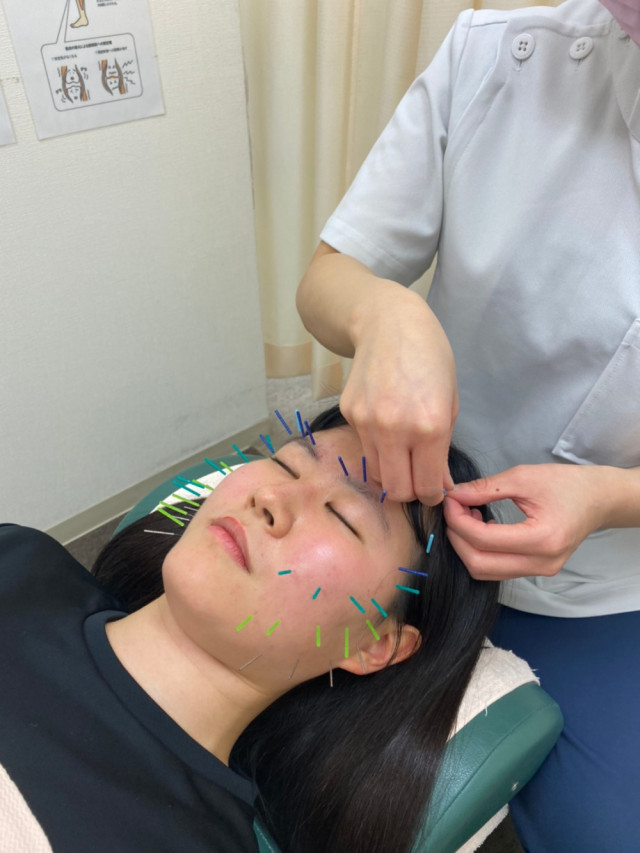 美容鍼